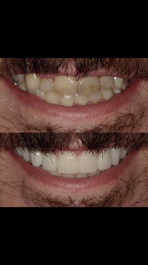 Smile Transformation 🔥 Check out our latest same day smile transformation that included 10 veneers, gum contouring & a dental bridge. Our patient was so happy with their healthy and transformed smile. Let’s chat about what your possibilities are 🤩🤩 📍Knoxville, TN 📞 865.531.1715 📩 dentalimages1715@gmail.com . . . #fyp #dentalimagesknoxville #westknoxville #tennessee #knoxvilledentist #knoxvilletn #dentalhygienist #foryou #knoxville #dentalreels #veneers #smiledesign #samedaysmile | Dental I