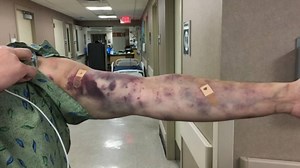 Unknown bug bite covers Arizona man’s arm in bruises, leaves him in ‘excruciating pain’