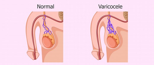 ¿Qué es el varicocele testicular? - Causas, síntomas y tratamientos