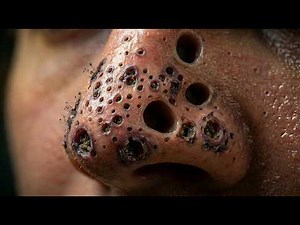 Nose Blackheads Removal | Full Deep Pore Cleaning Transformation