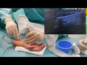 Ultra Minimally Invasive Ultrasound-Guided WALANT Carpal Tunnel Release