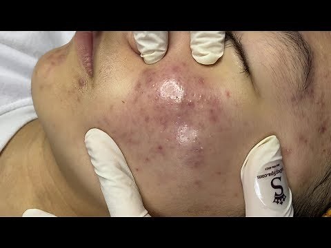 Acne Hematoma On Cheeks And Forehead | Mụn Viên Tụ Máu Hai Bên Má Và Trán - SacDepSpa#65