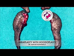 Labiaplasty Surgery | Designer Vagina | Labia Minora Reshaping