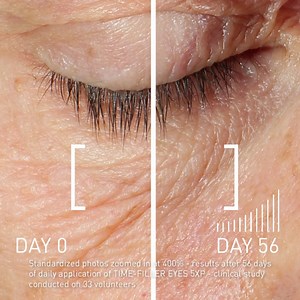 See the impact of using TIME-FILLER EYES 5-XP on under-eye wrinkles through these images! | Laboratoires Filorga