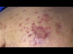 Acne Treament Under The Skin #003