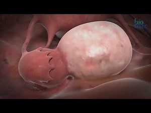 ELLA® - Animation laparoscopic laser procedures with LEONARDO® DUAL by biolitec®