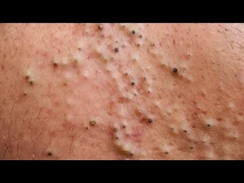 Blackhead Extraction Remove