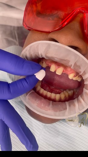 📸 Perfect Smiles in the Blink of an Eye! 😁💎 💎 With our porcelain veneers, crowns, and bridges, we can restore the natural appearance of your teeth, giving you a radiant and long-lasting smile. | Dental Design Smile