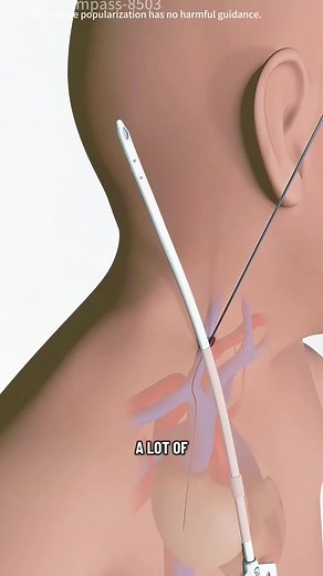 Tunneled Dialysis Catheter Placement (3D Animation) #dialysis #dialysispatient #dialysiscatheter #tunneleddialysiscatheter #catheter