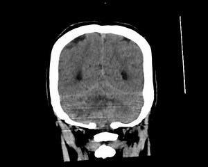 Ct Scan Brain Tumorbrain Tumors Can: стоковое видео (без лицензионных платежей), 1054187639 | Shutterstock