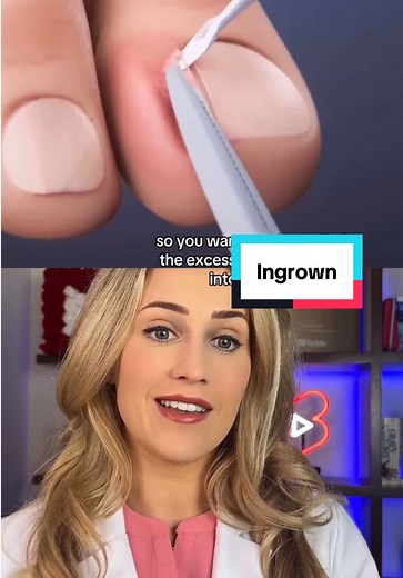 Effective Ingrown Nail Treatment and Removal Guide