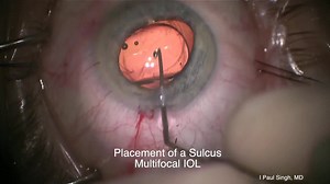 Use of CALLISTO eye to Verify the Centration of a Multifocal Lens Exchange - Eyetube