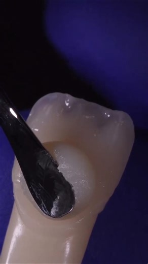 composite veneers. composite restoration front teeth