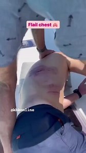 Flail chest — defined as two or more contiguous rib fractures with two or more breaks per rib — is one of the most serious of these injuries and is often associated with considerable morbidity and mortality. It occurs when a portion of the chest wall is destabilized, usually from severe blunt force trauma. #kbkfoundation | Kbkonline | Facebook