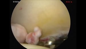 Synovial Chondromatosis of the Hip