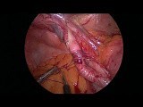 Laparoscopic Management of a Strangulated Internal Hernia Underneath the External Iliac Artery with Parietal Peritoneal Patch Reconstruction • Video • MEDtube.net