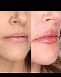 Pretty Plump Lippies created with 1 syringe of Juvederm Ultra Plus XC. Did you know that dermal filler actually hydrates the lips with Hyaluronic Acid!? 💋💦💦💦💦 ———————————————— DM for more info. on our pain-free lip augmentation procedure #californiacosmetics #bestlips #beautytips #dermalfillers #plumplips #lipgoals #lippies #californiacosmeticstechnique #beauty #beautyinspo #instabeauty | California Cosmetics