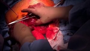 Intra-Articular Glenoid Fracture ORIF via Modified Judet Approach: Case Presentation and Surgical Technique