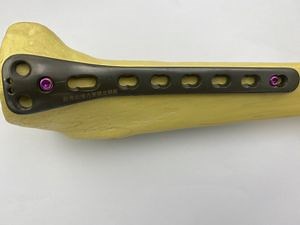 [Hot Item] High Quality Pure Titanium Orthopedic Implants Proximal Tibial Medial Locking Compression Plate with CE Certificate