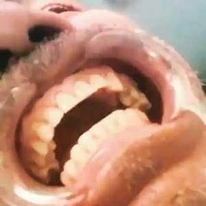 21K views · 278 reactions | Alveolar Bone Fracture  | Dr.Sreenath S | Facebook