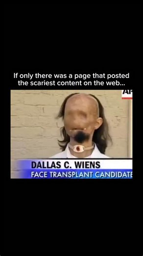 SCARY MEMES on Instagram: "On November 13, 2008, Texas construction worker Dallas Wiens sustained severe facial burns in a high-voltage electrical accident. This footage captures him before and after his full face transplant."