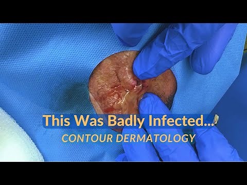 Incision & Drainage on an Infected Cyst | CONTOUR DERMATOLOGY