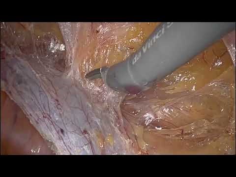 Robotic Repair of Bilateral Inguinal Hernias - Direct