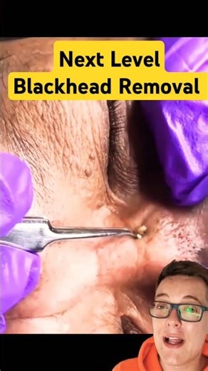Amazing BLACKHEAD REMOVAL - Best Solar Comedones Ever #shorts