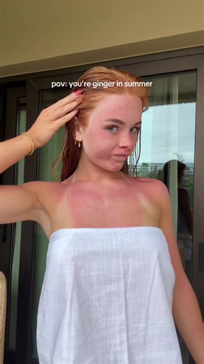 Being a Ginger in Summer: A Relatable POV
