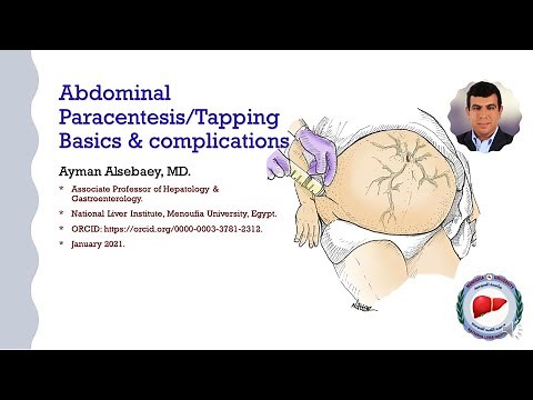 Abdominal ParacentesisT apping Basics & complications.