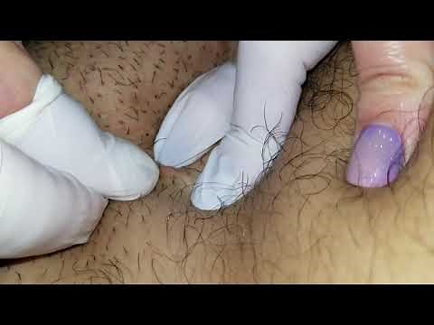 Pimple popping for pleasure in groin area