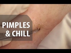 Pimples & Chill | Dr. Derm