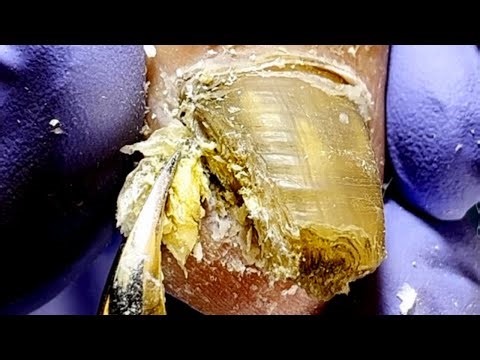 Super Thick Onychomycosis, As Rotten As Dead Wood【Podiatry Clinic】