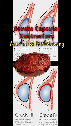 Capsular Contracture- Breast Implant painful hardening #capsularcontracture #capsulectomy #implants