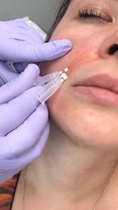 We absolutely love using PDO Smooth Threads to help replace mild volume loss, tighten skin, and smooth lines! AAFE Valentines tuition savings are going on now! Fall in love with your Practice again - we're here to help! Invest in your career, increase your skills, and learn the best techniques available for facial esthetics and injectables! Give us a call now at 800 952-0521 or email info@facialesthetics.org! Visit aafetraining.com to learn more!⠀⠀⠀⠀⠀⠀⠀⠀⠀ ⠀⠀⠀⠀⠀⠀⠀⠀⠀⠀⠀⠀⠀⠀⠀⠀⠀⠀⠀⠀ If you are a patien