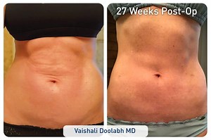 J-Plasma Skin Tightening Scottsdale | Renuvion Phoenix | Infini Skin