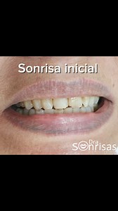 Diseña tu sonrisa 👉👄👈 Citas Whatsapp 6861613929 Dra. Sonrisas 🦷👄👩‍⚕️ | Dentista Mexicali/ Dra. Sonrisas