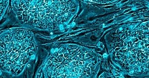 Syndrome de Zellweger: causes, symptômes et traitement - yes, therapy helps!