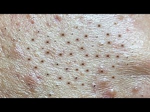 Satisfying video with Hien Nguyen Spa Beauty #002