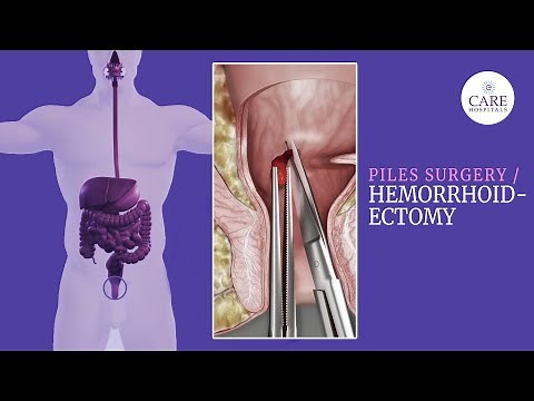 Your Ultimate Guide to Piles Surgery Hemorrhoidectomy