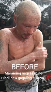 855K views · 8.3K reactions | Follow up check up : PSORIASIS skin disease Dating Puno Ng sugat at mga tuyo na Balat buong katawan.. Di maka tulog sa sobrang kati Ng buong katawan . At Di makaligo sa sobrang sakit... Ngayon magaling na.. | Master Justine Castillo | Facebook