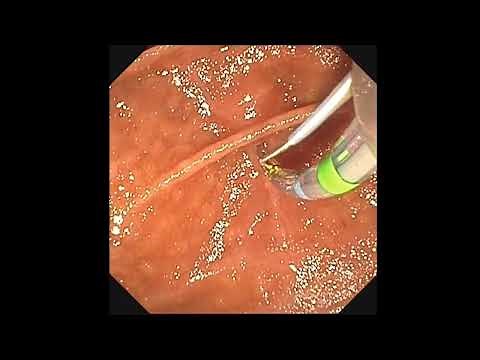 Submucosal injection to facilitate needle-knife sphincterotomy: a novel technique