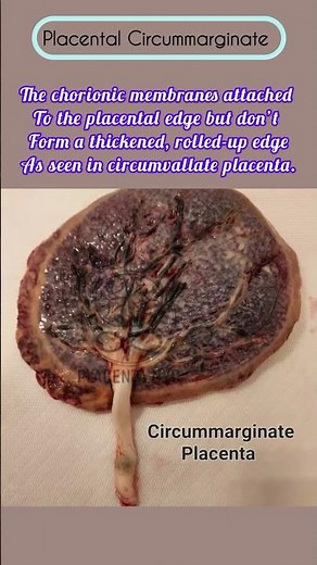 Placenta Abnormalities #medicalexaminations #nursing #motherandbaby