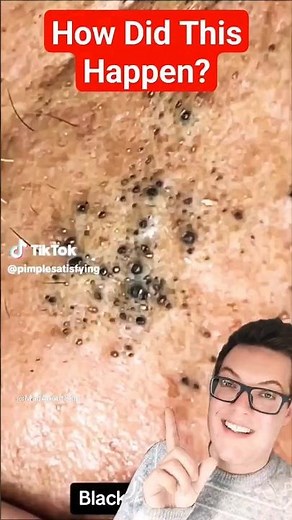 Crazy CLUSTER BLACKHEAD REMOVAL - Unbelievable #shorts