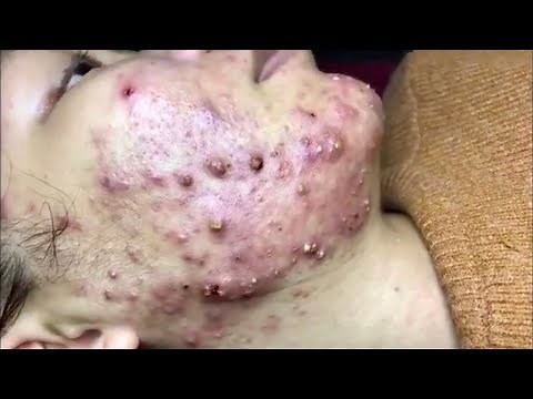 blackheads new this week | popping pimple asmr |pimple popping | acne