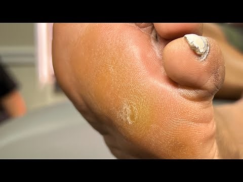 EXTREMELY SATIFYING CALLUS SHAVING 🥲