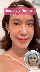 #DRKReview Upper Lip Reshape Sub Brow Lift Thanks for choosing DRK 🫰🥰 Why Lip Reshape Surgery ? 💋 For those who having uneven or thin lip porportion, we want to introduce you to Lip Reshape Surgery. This Surgery could lift your lips and bring them into better proportion. You'll have more thick, better porportion and more attractive lips so far Visit 🌐 www.drkbeauty.com to learn more about our services. 📱 DMs if you require more information or Contact other channels at 💚 Line @drkbeautyclin