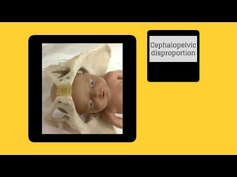 Topic 22: Abnormal Labor