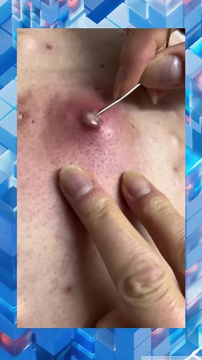 Ultimate Acne Pimple Popping Kit for Satisfying Results