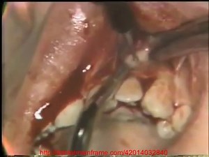 SEGMENTAL MAXILLARY OSTEOTOMY
